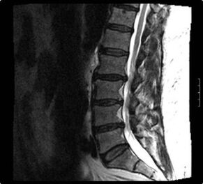 рентгеновский снимок шейного отдела при остеохондрозе