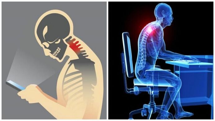 сидячая работа и сутулость как причины развития остеохондроза