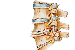 защемленный диск позвоночника как причина шейного остеохондроза